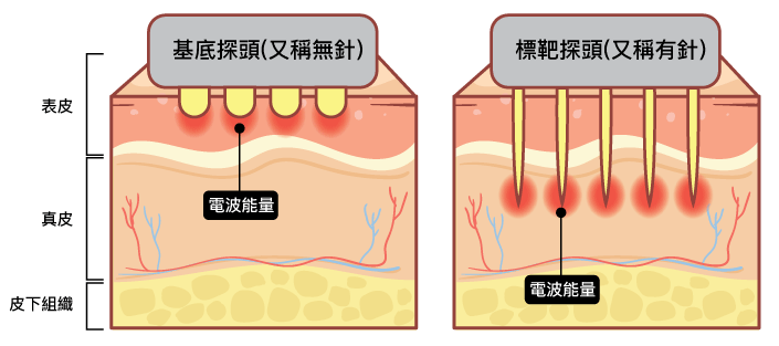 4D標靶電波兩種探頭
